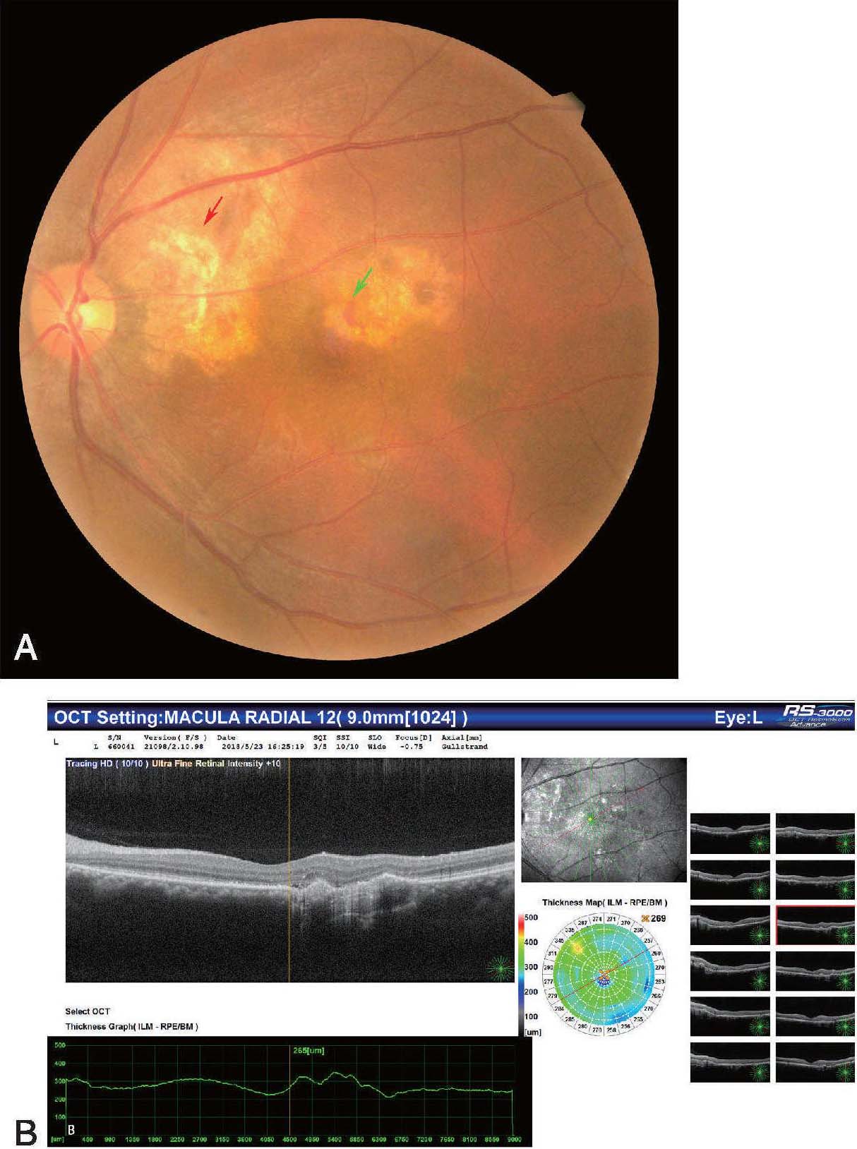 病例7-2-1 诊断:左眼脉络膜骨瘤，PDT治疗后； 左眼CNV，抗VEGF治疗后。